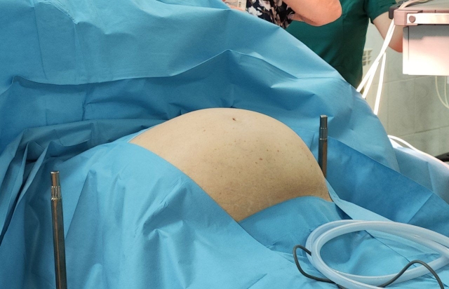 <i>В Дагестане женщине вырезали опухоль размером с арбуз</i>
