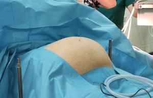 В Дагестане женщине вырезали опухоль размером с арбуз